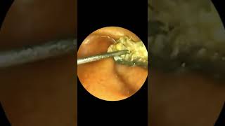 Ear Wax Remains Liquid and Difficult to Clean [upl. by Latsyrhc]