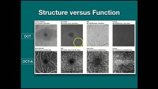 OCT Angiography with Graham Lakkis BScOptom [upl. by Trudi230]