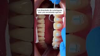 ¿Ya conocías los brakets de autoligado 👀 [upl. by Nalorac626]