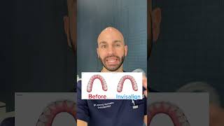 Can Invisalign Close Spaces Between Teeth 2024 [upl. by Dorcia]