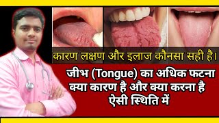 Cracked Fissure On Tongue जिव्हा पर गहरी दरार बनना कारण लक्षण और इलाज Best Homeopathic Treatment [upl. by Gerald]