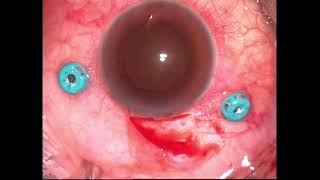 Iron foreign body removal in an eye with siderosis [upl. by Alvin]