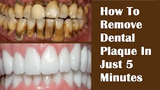 How To Remove Dental Plaque In Just 5 Minutes  Remove Tartar On Teeth FAST HealthyPunchToday [upl. by Epolulot]