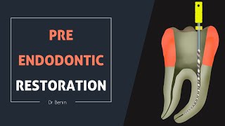 Pre Endodontic Restoration [upl. by Oflodur]