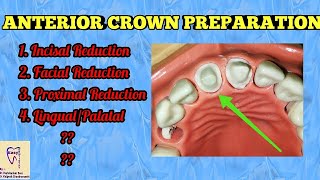 Crown Preparation for anterior  Crown cutting [upl. by Dail]