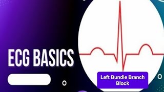 ECG Basics  Left Bundle Branch Block LBBB  Causes of LBBB [upl. by Vacla]