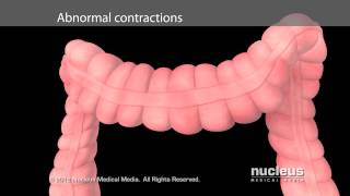 Irritable Bowel Syndrome IBS [upl. by Barbabas]