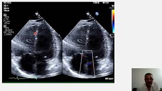 McConnell sign RV strain pulmonary embolism vs RV infarction pulmonary hypertension [upl. by Nyladam]