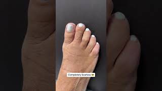 MINIMALLY INVASIVE BUNION amp CROOKED TOE TRANSFORMATION ♥️shorts [upl. by Haneekas]