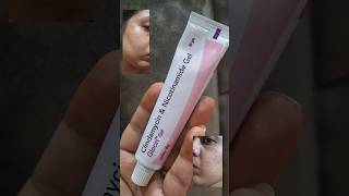 remove pimples in 34 days glocin gel review shorts ytshorts viralshorts acne viral pharmacy [upl. by Ruff488]