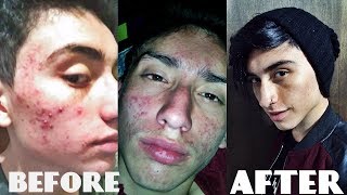 ELIMINA EL ACNE CON ISOTRETINOINA  Me curo el acne 100 [upl. by Igic]