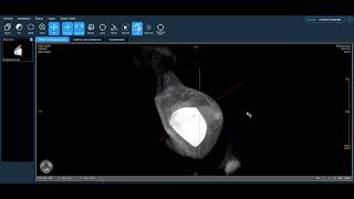 Koning Clinical Overview Ductal Carcinoma in Situ Implant [upl. by Odlaniger]