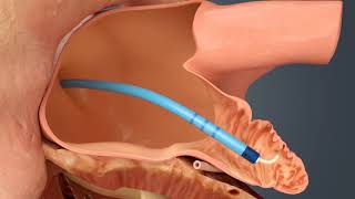 WATCHMAN Procedure for Atrial Fibrillation [upl. by Annovahs]