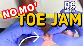 Trimming of Fungal Toenails and Calluses In A Diabetic Patient  No Mo Toe Jam [upl. by Bosch79]