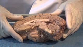 The Ventricles Neuroanatomy Video Lab  Brain Dissections [upl. by Welcher]