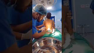 Spinal Anesthesia inserted in epidural  Spinal Anesthesia procedure spinalanesthesia anesthisa [upl. by Nerdna]