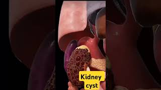 The kidney cyst neet mbbs doctor [upl. by Rotce]