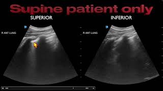 POCUS Misdiagnosis of Pneumothorax [upl. by Nalhsa]