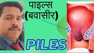 Hemorrhoids Treatment in Hindi  Piles ka Ilaj  पाइल्स के कारण लक्षण डायग्नोसिस और उपचार [upl. by Leuqcar]