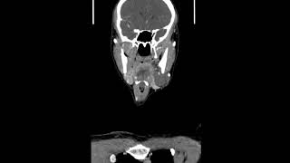 Submandibular Gland Arteriovenous Malformation with Phleboliths Coronal CT scans [upl. by Rains203]