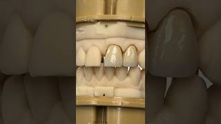 Central and Lateral IncisorsEnvisiontecMain envisiontec lsk121shorts dentist teeth [upl. by Annenn]