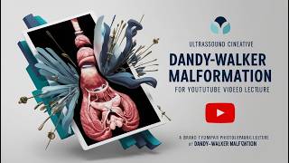 Fetal Neurosonography DandyWalker Malformation [upl. by Ainolopa]