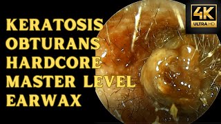 Keratosis Obturans  The Hardcore Master Level Earwax Extraction [upl. by Juanita]