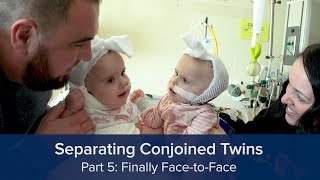 Separating Conjoined Twins Part 5 Finally FacetoFace [upl. by Darian]