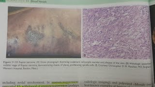 Kaposi Sarcoma  SPECIAL PATHOLOGY [upl. by Arlynne]