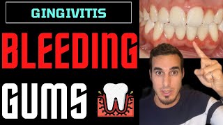 GINGIVITIS treatment and symptoms  INFLAMED GUMS and GUM DISEASE [upl. by Kirstin789]