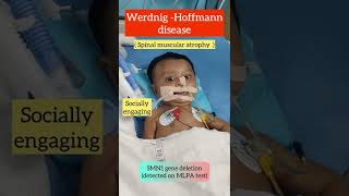 floppy baby  spinal muscular atrophy  werdnighoffmann disease  neurology shorts [upl. by Dow]