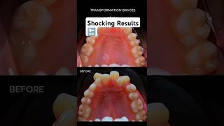 Shocking results 🔚🤬result braces dentist orthodontist shorts [upl. by Ahsinom901]