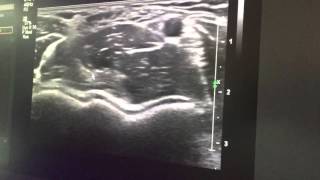 Demo echografie elleboog Biceps Arterie Medianus BAM [upl. by Zabrine]