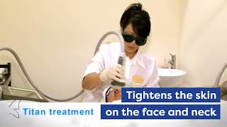 NonInvasive Skin Tightening with Titan [upl. by Ibby485]