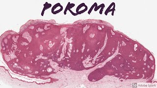 Poroma 5Minute Pathology Pearls [upl. by Afrikah847]