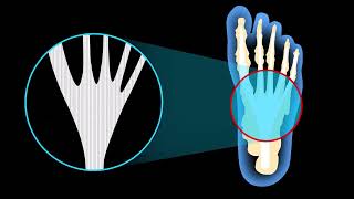 The Cluffy insole enhances the windlass mechanism for plantar fasciitis heel pain resolution [upl. by Rebmyk217]