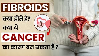 Fibroids क्या होते है इसके कितने प्रकार होते है  कारण लक्षण उपाए  Dr Megha Chaturvedi [upl. by Gigi]