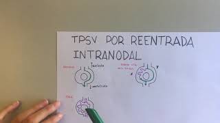 TAQUICARDIA por REENTRADA INTRANODAL [upl. by Rubinstein]