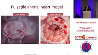 FORTIS Transcatheter Mitral Valve Implantation [upl. by Neleh553]