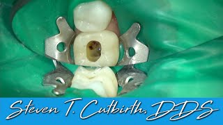 Endo Through a Molar Crown  with Steven T Cutbirth DDS [upl. by Eelnyl636]