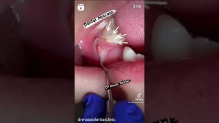 Dental Abscesses on baby tooth [upl. by Rennob74]