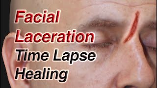 Facial Laceration Time Lapse Healing via Secondary Intention [upl. by Ahsap]