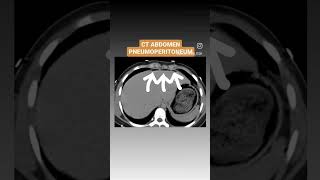 Pneumoperitoneum CT Scan Abdomen shorts youtubeshorts viral [upl. by Lexi]