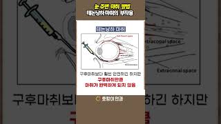 눈 주변 마취 방법 테논낭하의 부작용 망막수술유리체절제술유리체절제술과정 유레체절제술 방법 [upl. by Aelram]