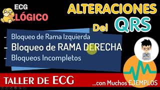 BLOQUEO completo e incompleto DE RAMA DERECHA BCRD CASO CLINICO EJERCICIOS [upl. by Race492]