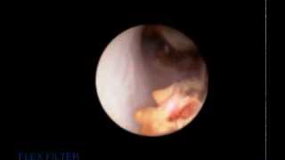 Ureteroscopy and laser fragmentation of stone [upl. by Therine]