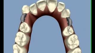 Invisalign clincheck ortholemay 133042 LA21 [upl. by Mayram]