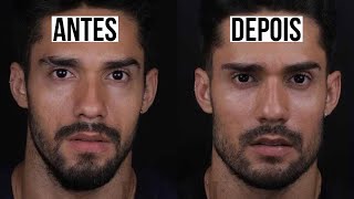 ANTES E DEPOIS DA HARMONIZAÇÃO FACIAL MASCULINA  ALEX CURSINO [upl. by Arreis901]