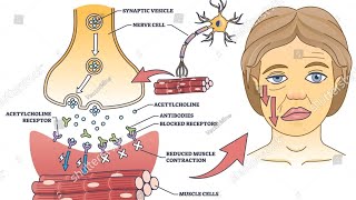 Myasthenia Gravis  the effects [upl. by Lessig]