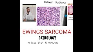 Bone tumor Pathology Ewing Sarcoma [upl. by Holton]